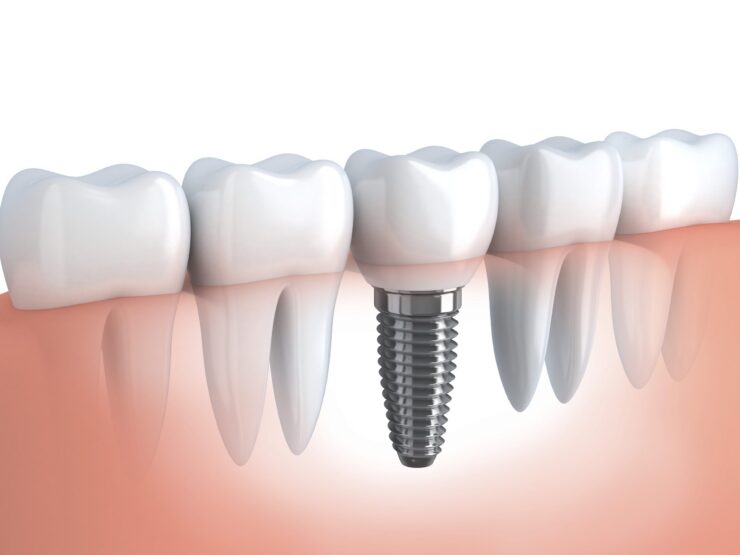 Dental implant with crown between natural teeth